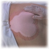 ALLEVYN Sacrum / Sacral Adhesive Foam Dressing1